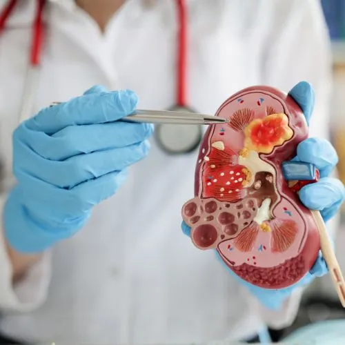 prezentacja kamieni nerkowych